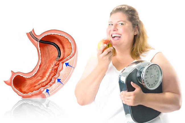 Fetmakirurgi - Här finns det mer information om fetmaoperationer.